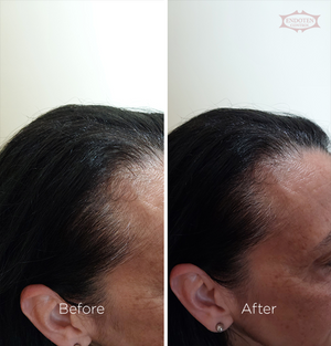 Endoten Control Serum- 90 Days Treatment  Challenge