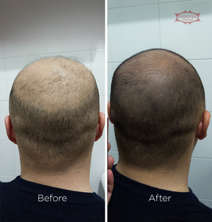 Endoten Control Serum 200 ml - 30 Days Treatment