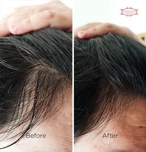 Endoten Control Serum- 90 Days Treatment  Challenge